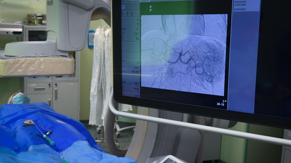 Radioembolization procedure for a patient with liver cancer